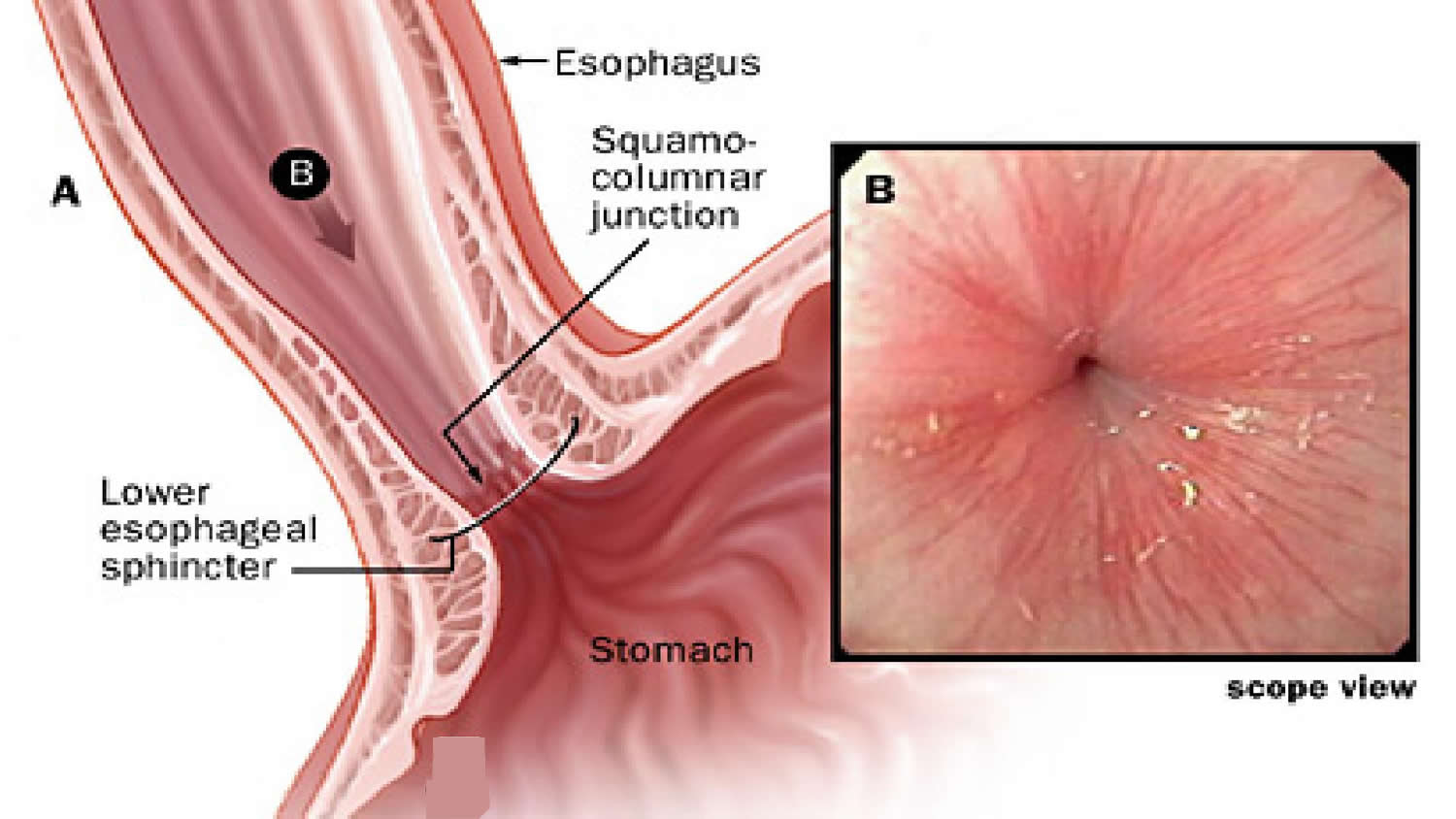 Anatomy of esophagus longitudinal muscle. LES, lower esophageal