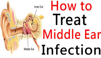 middle ear infection
