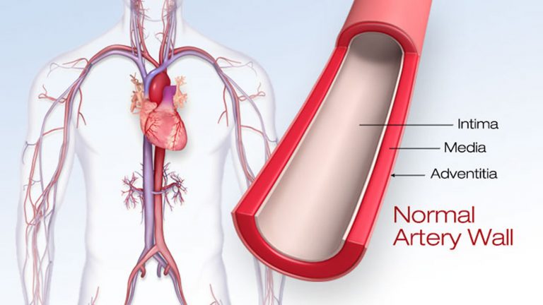 Clogged Arteries Causes Symptoms Signs Treatment And Prevention