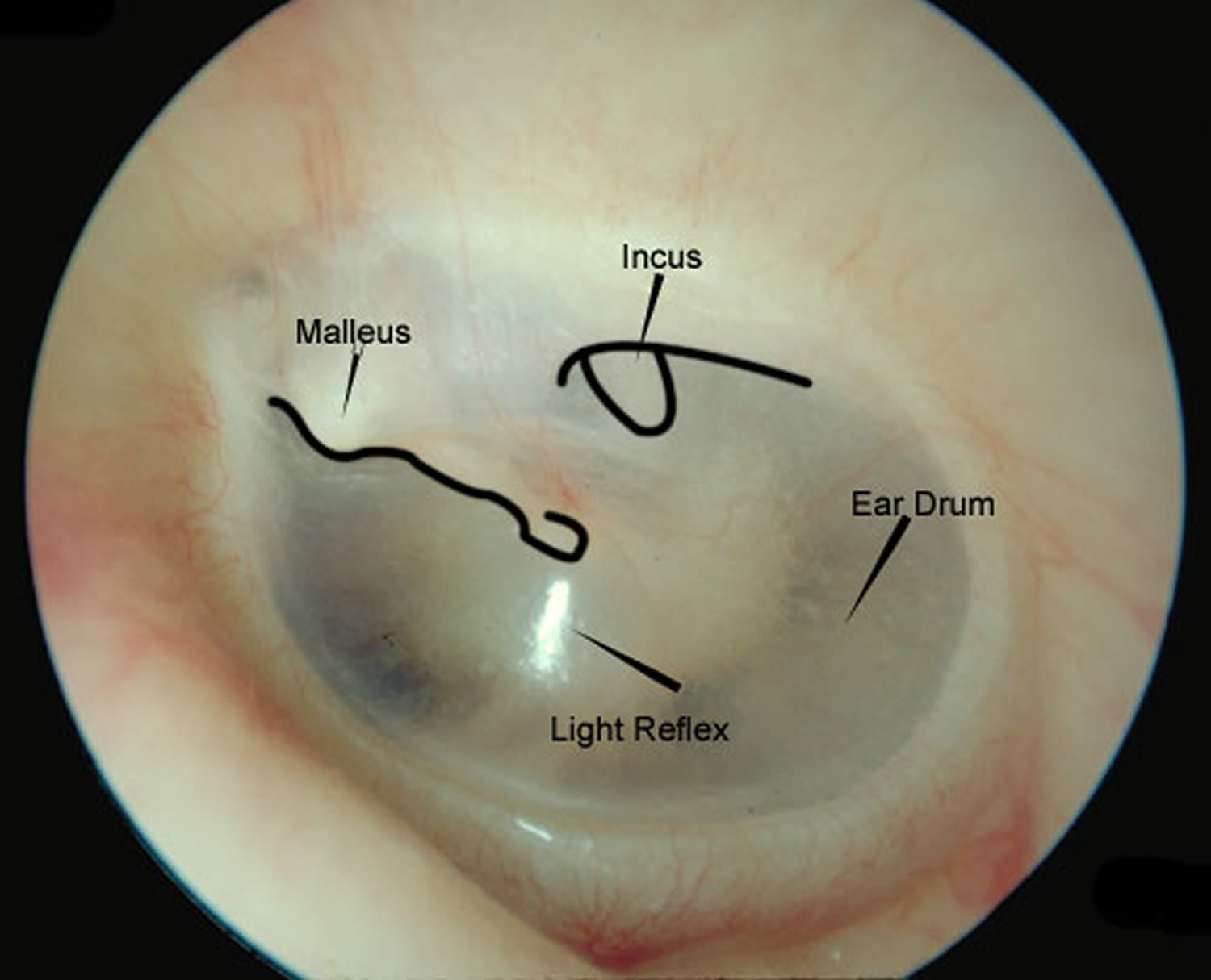 normal ear drum