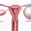 ovarian cyst