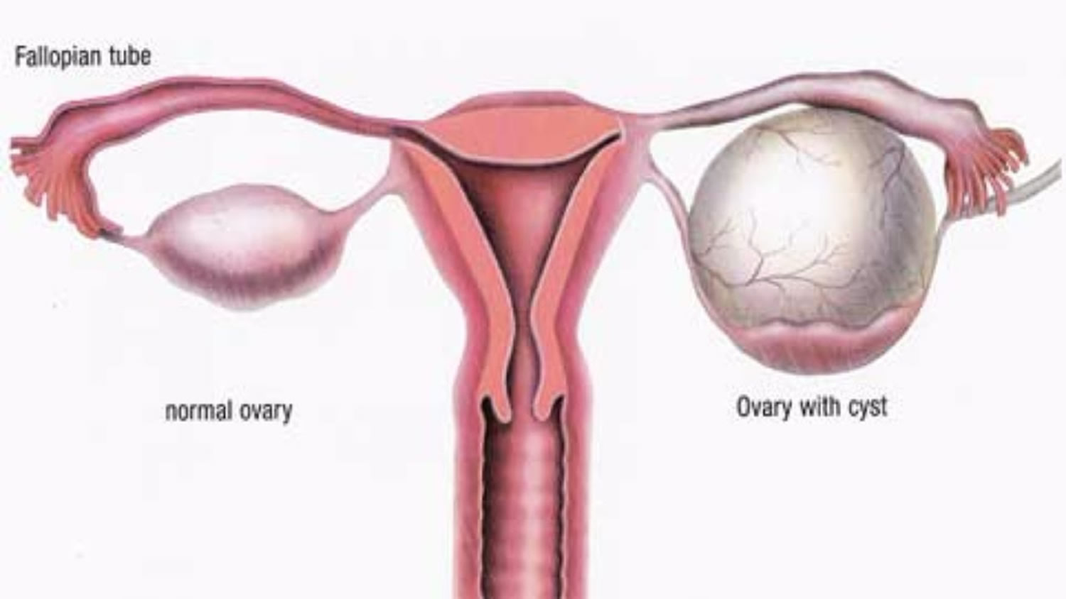 Ovarian Cyst Types