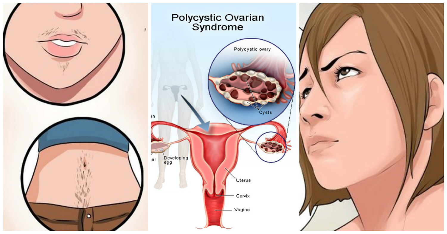 Polycystic Ovaries Symptoms, Diagnosis, Treatment