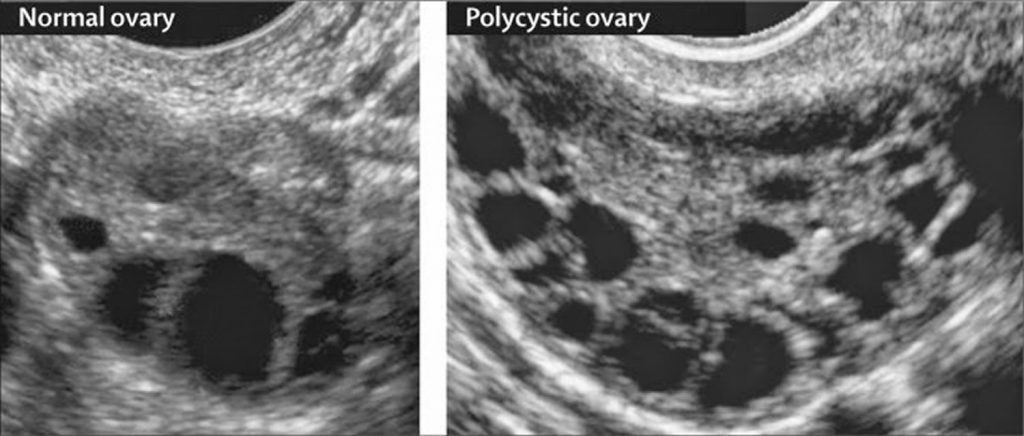 Polycystic Ovaries - Symptoms, Diagnosis, Treatment, Ultrasound and Diet