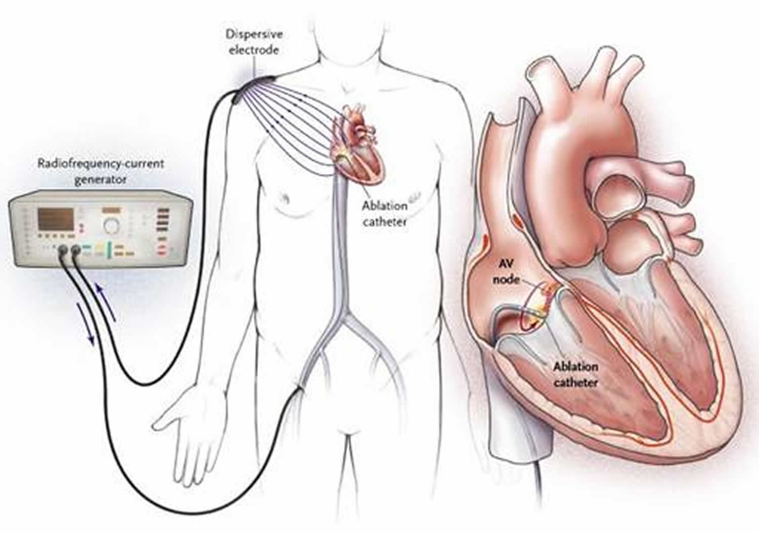 Heart Surgery Types Open Bypass Ablation Heart Valve Surgery