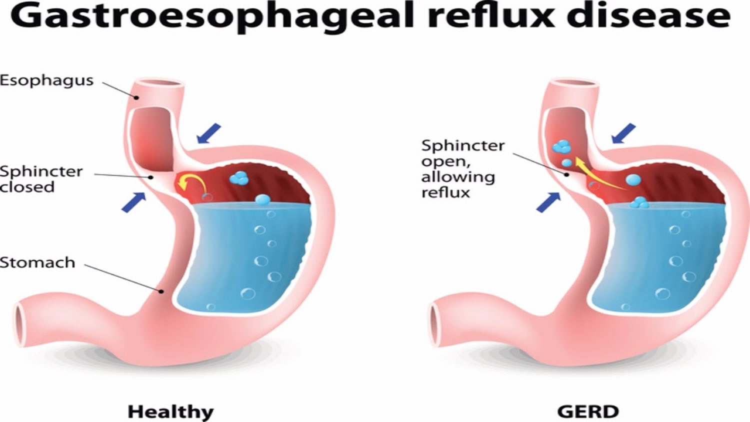 reflux esophagitis symptoms