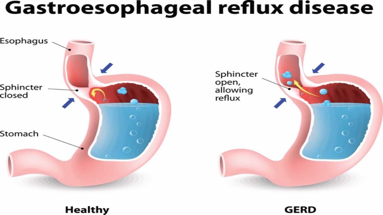 Stomach Burning After Eating - Causes, Symptoms, Treatment