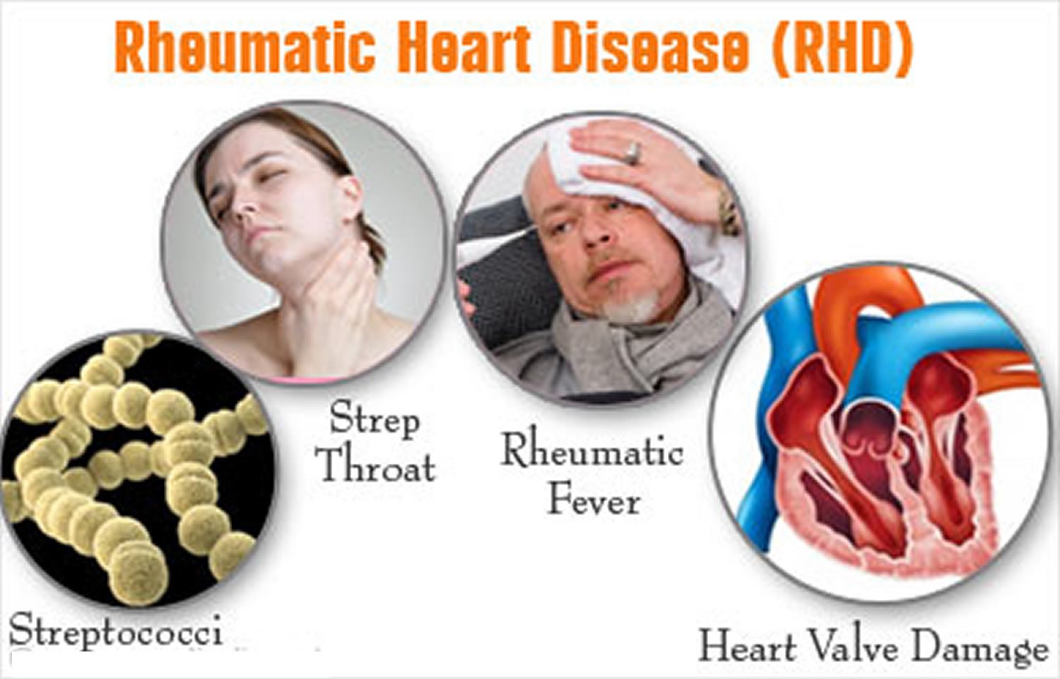 Rheumatic Heart Disease - Causes, Symptoms, Treatment & Prevention