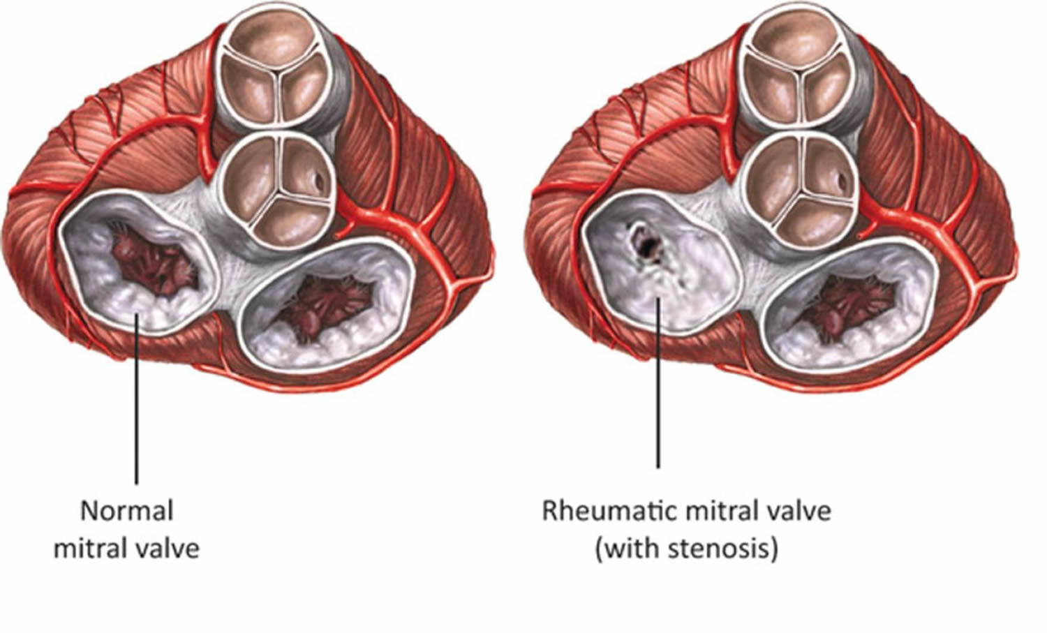 Nursing Management For Rheumatic Heart Disease