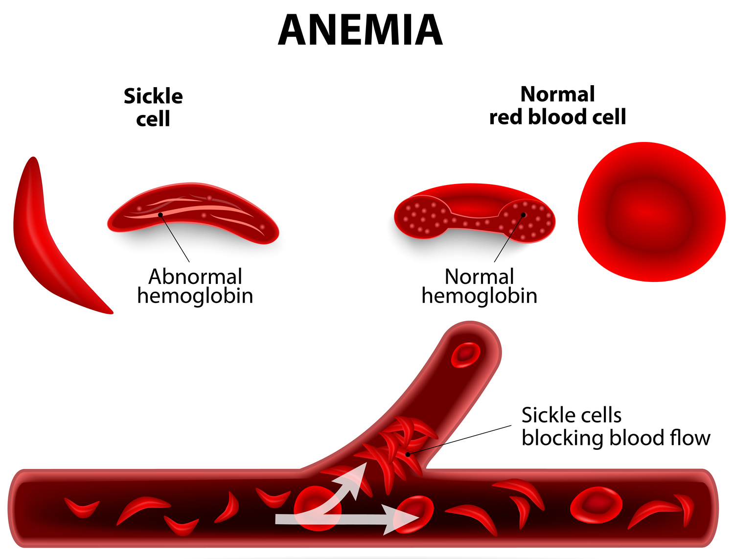 acute respiratory failure low hematocrit and hemoglobin