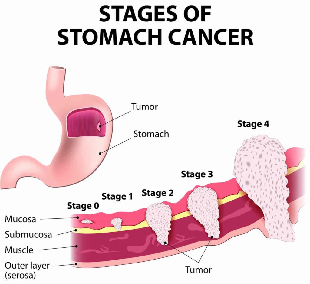 Stomach Cancer - Causes, Symptoms, Diagnosis and Treatment