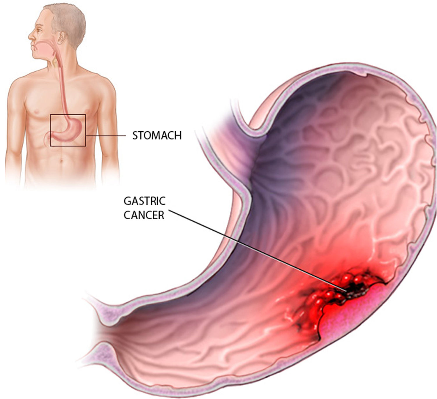 symptoms stomach cancer