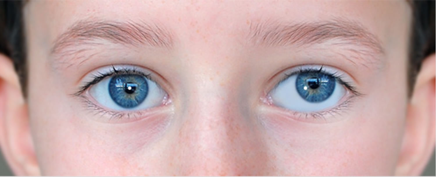 Can A Baby Develop Strabismus?