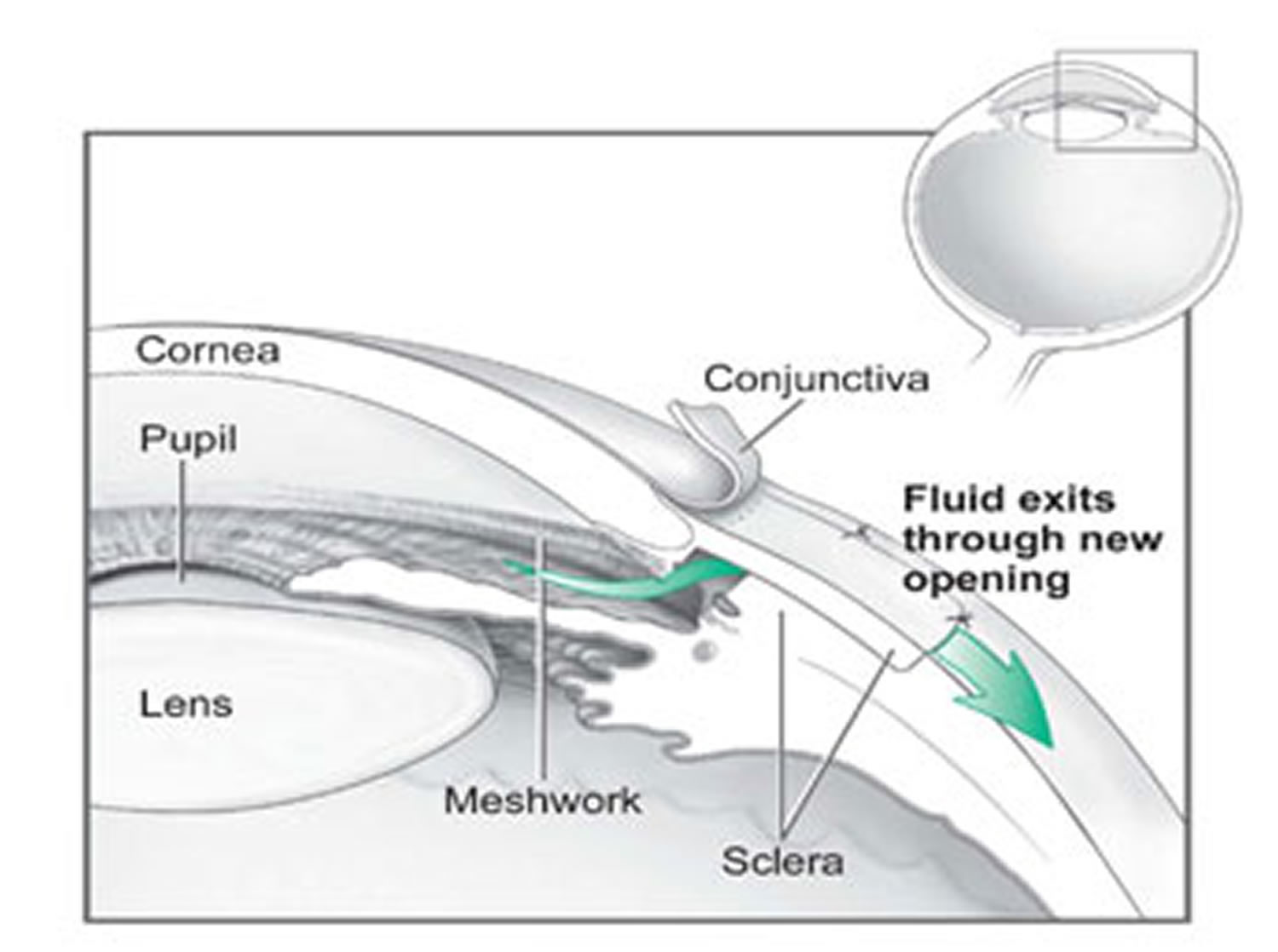 surgical treatment for glaucoma