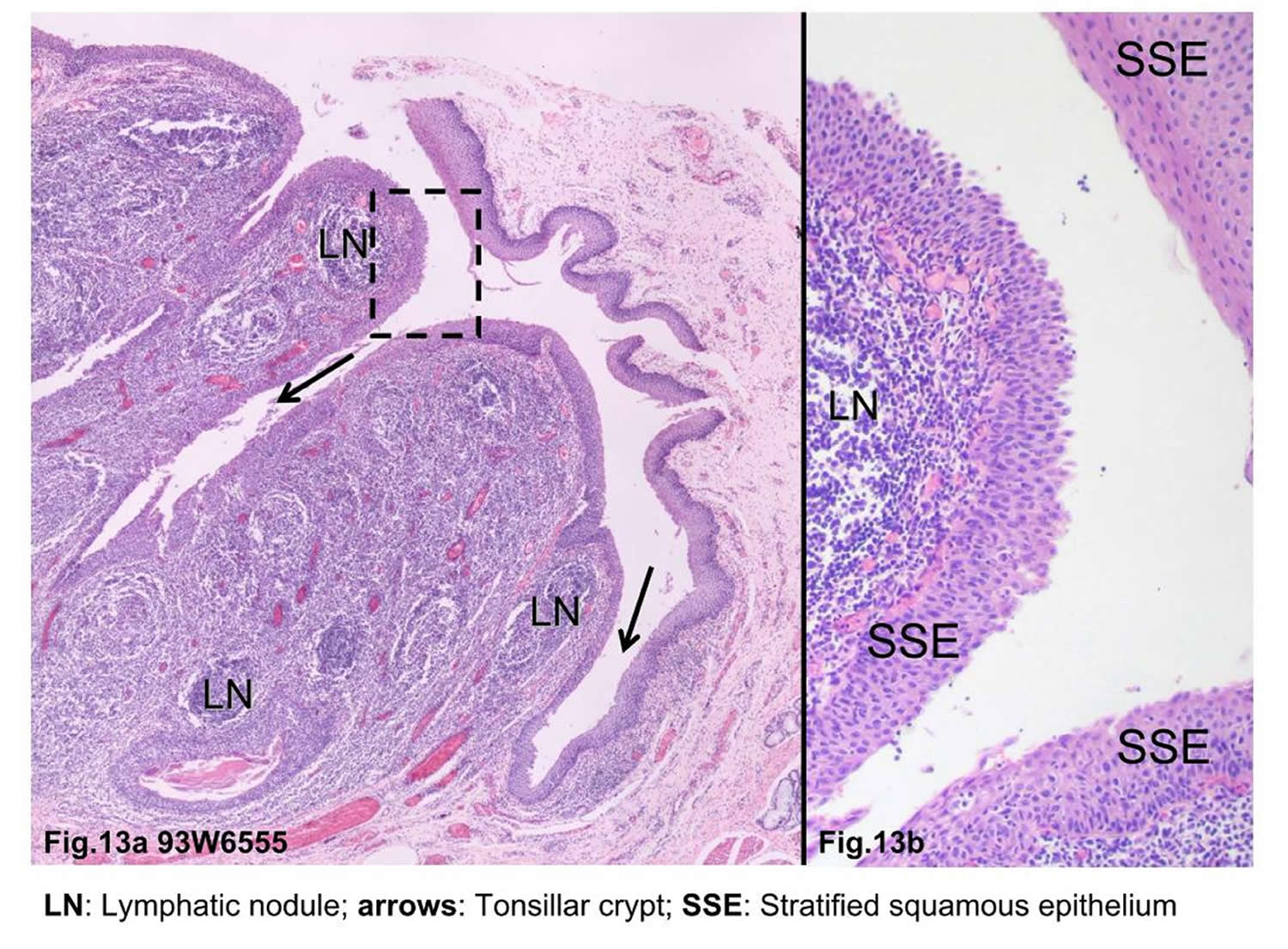 tonsillar crypt microscopy