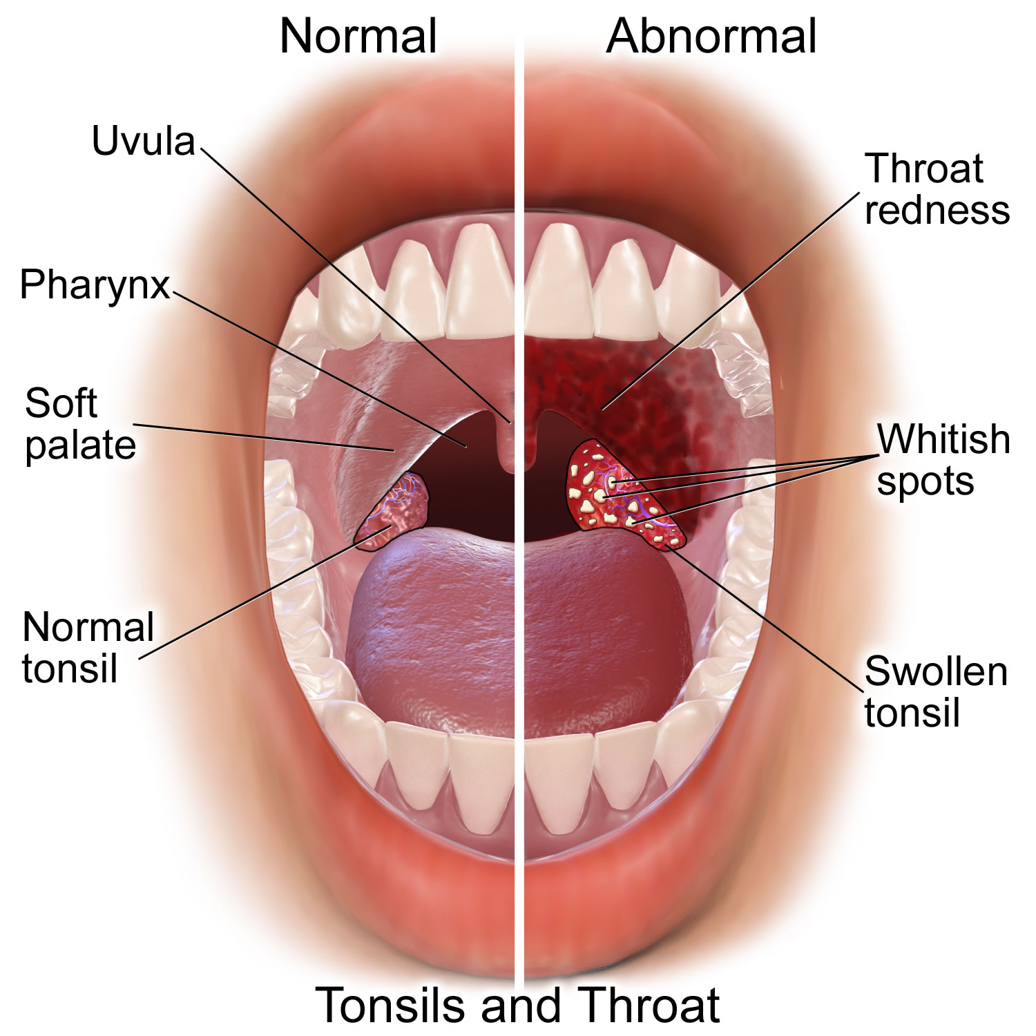 lingual tonsil bumps