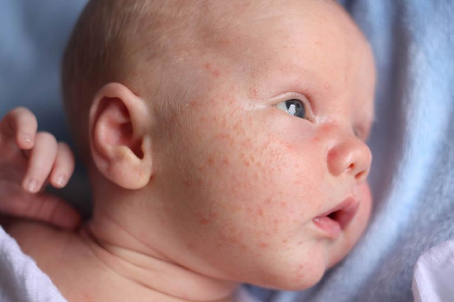 Skin Rash, Causes, Baby Skin Rash - Allergy, Fungal ...