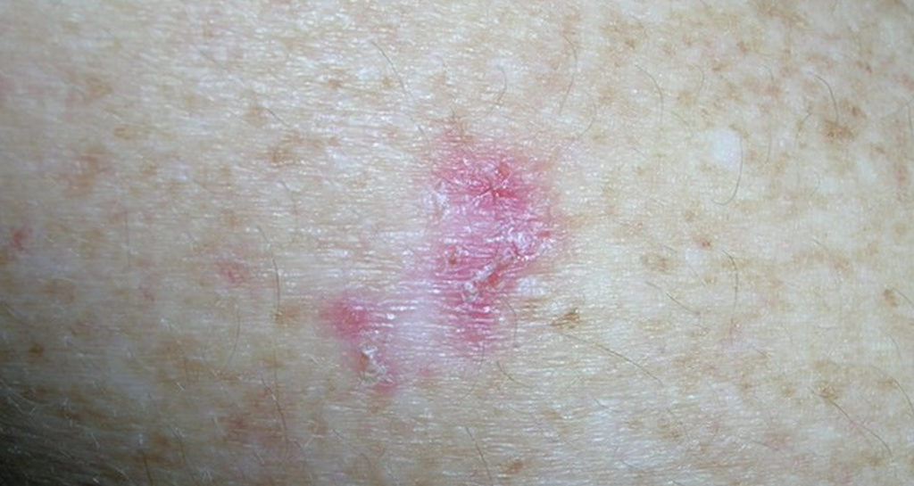 Skin Cancer - Types, Symptoms - Melanoma & Treatment