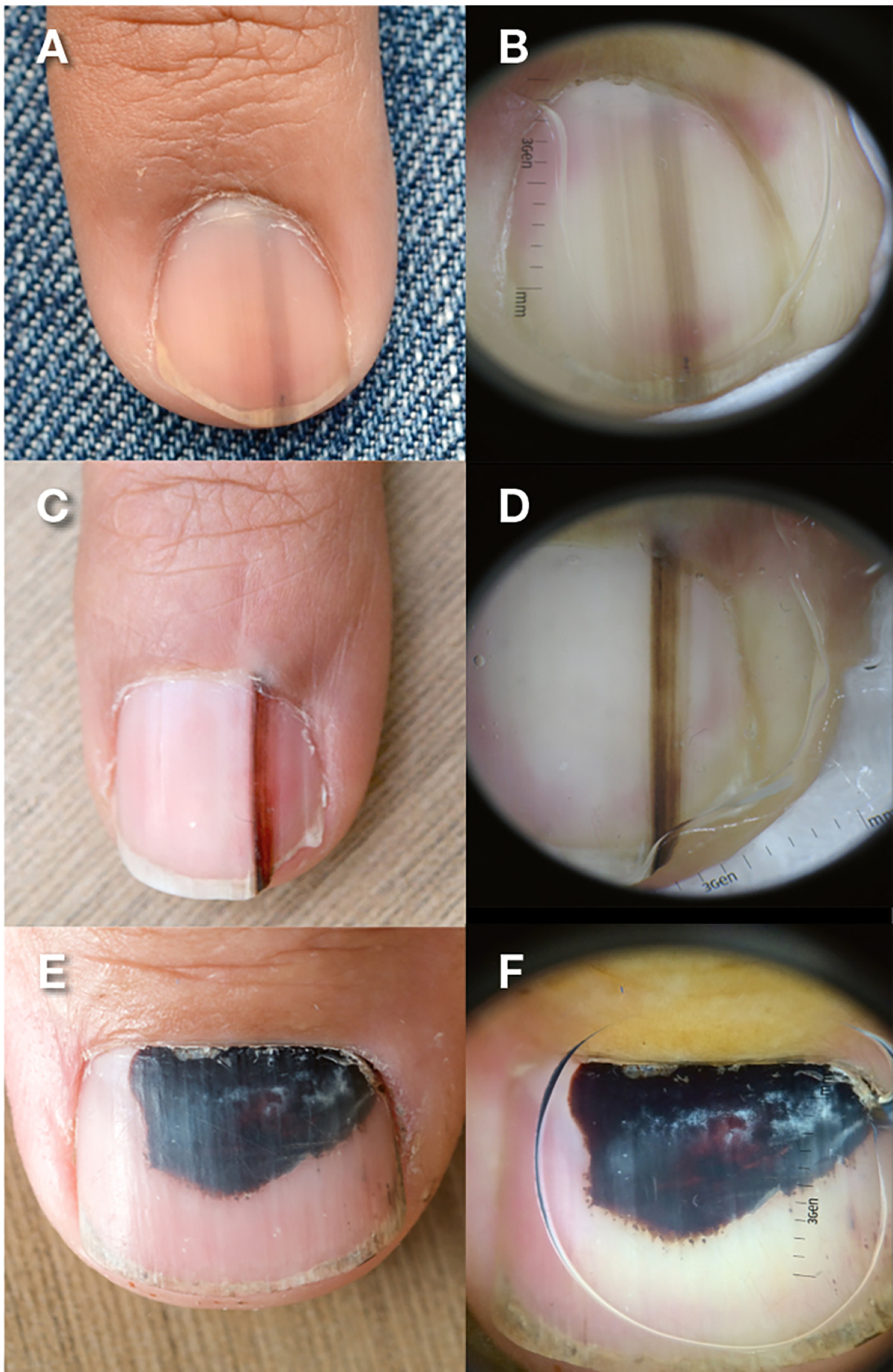 Black line and dot under nails.