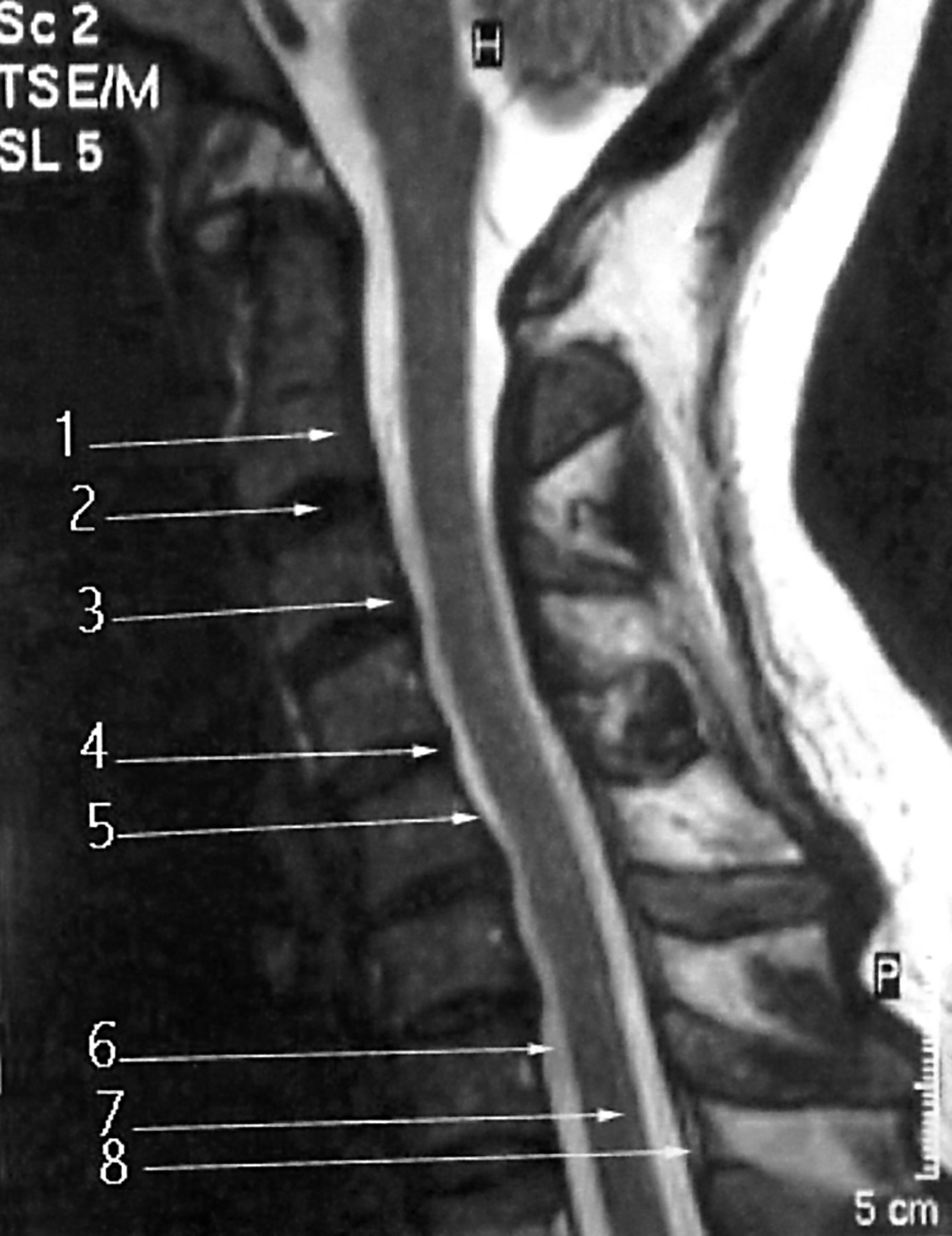 Cervical Spinal Cord Compression