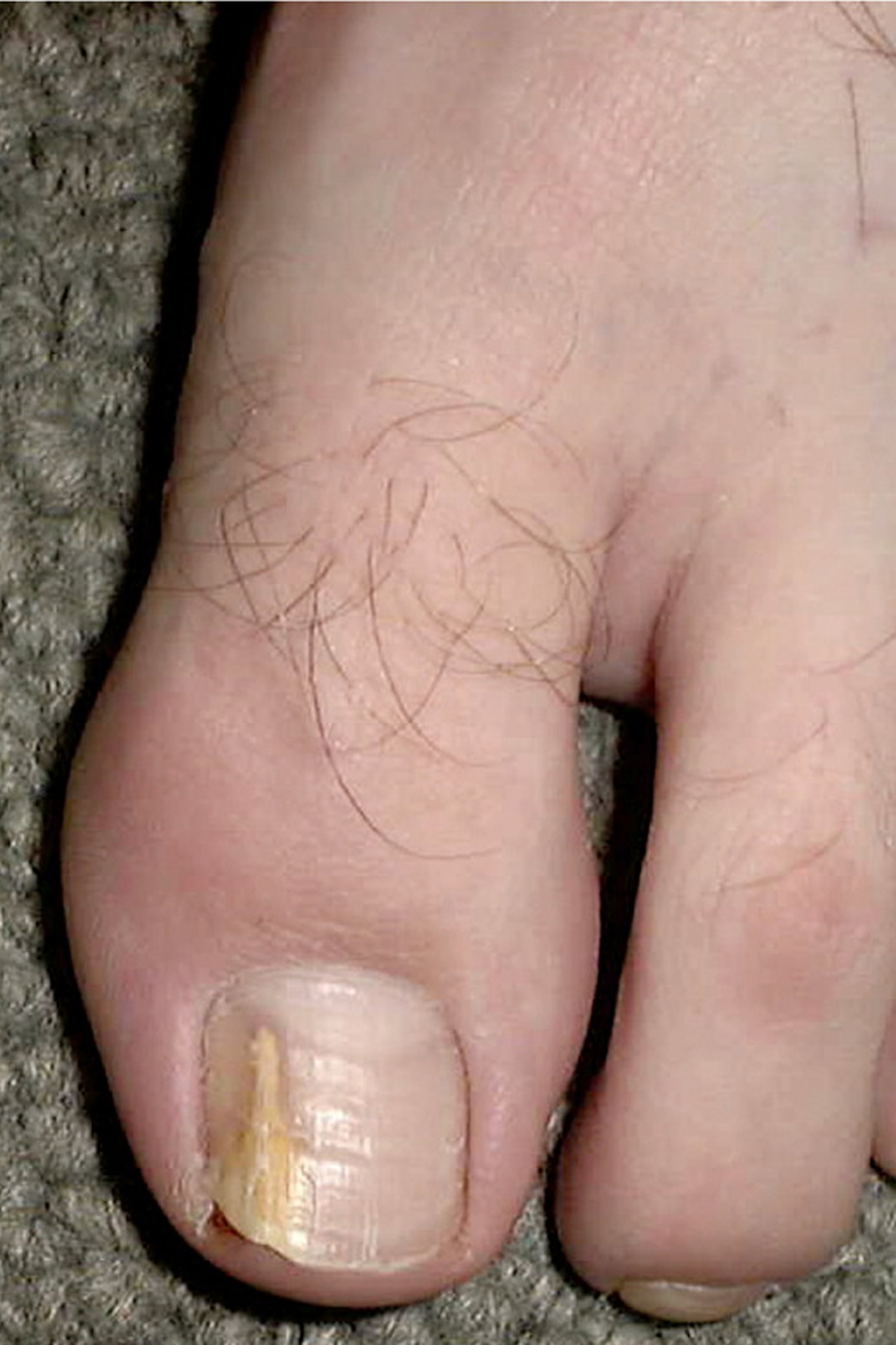 Distal and lateral subungual onychomycosis with spike deformity