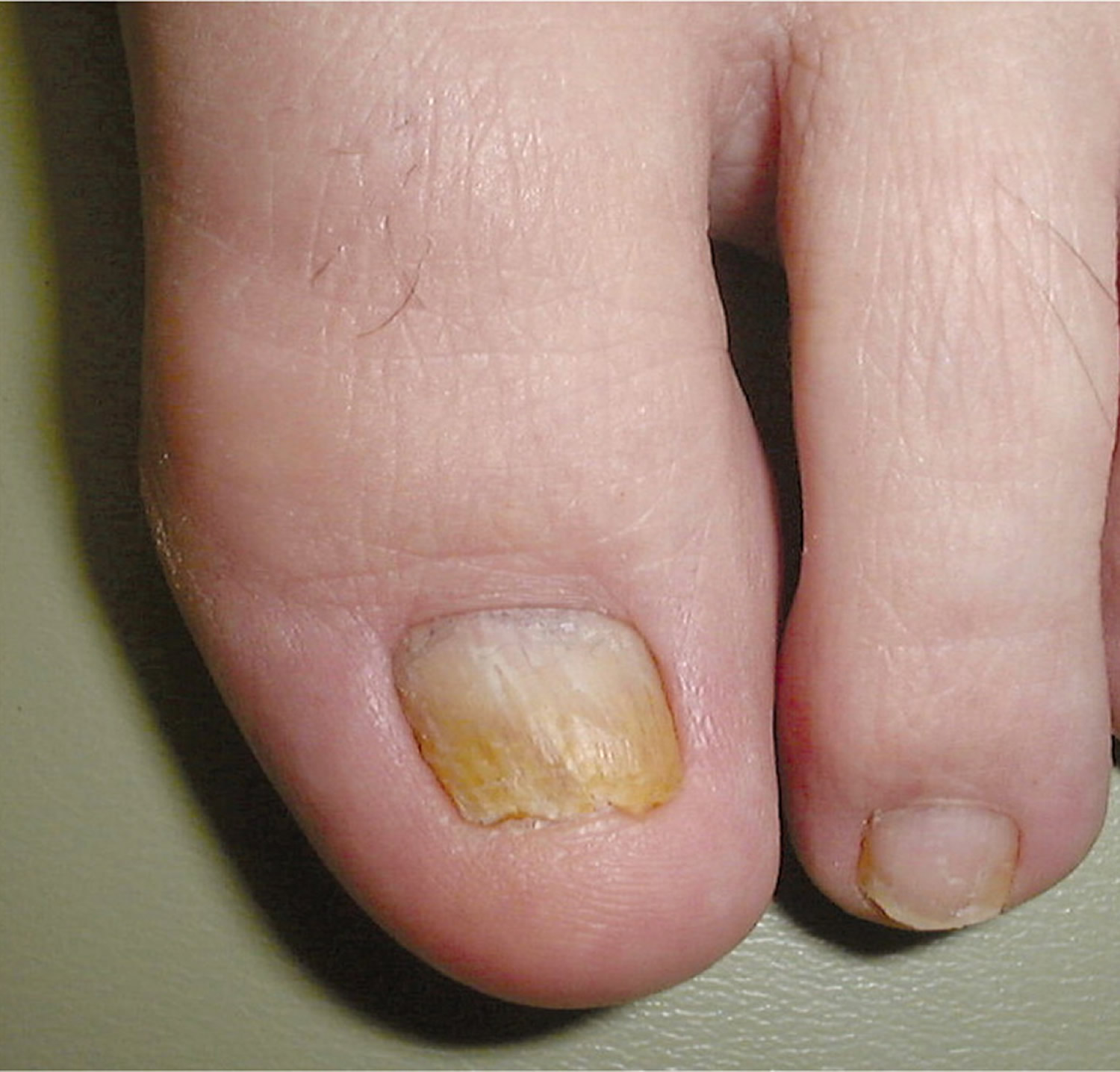 Distal and lateral subungual onychomycosis