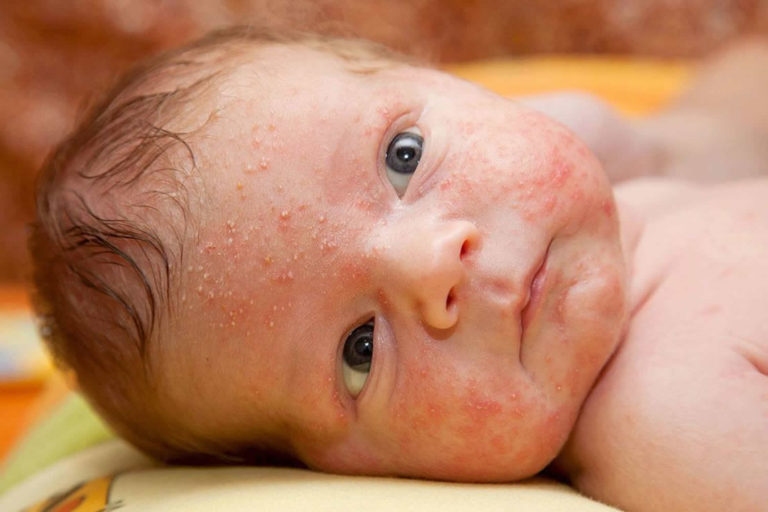 Skin Rash, Causes, Baby Skin Rash - Allergy, Fungal & Treatment