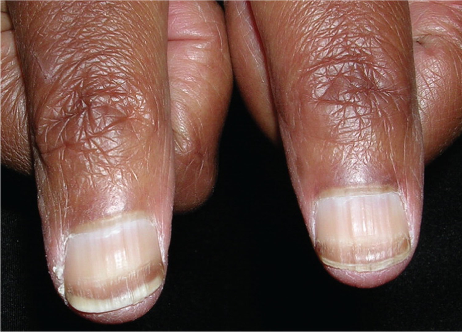 horizontal lines on the fingernails