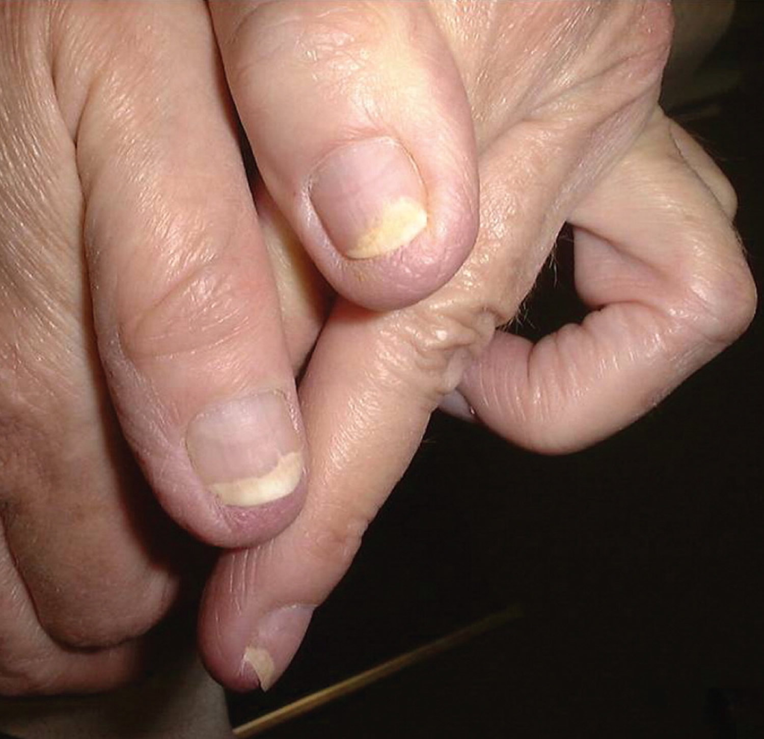 Fingernail fungal infection