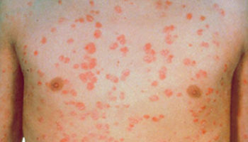 Guttate psoriasis