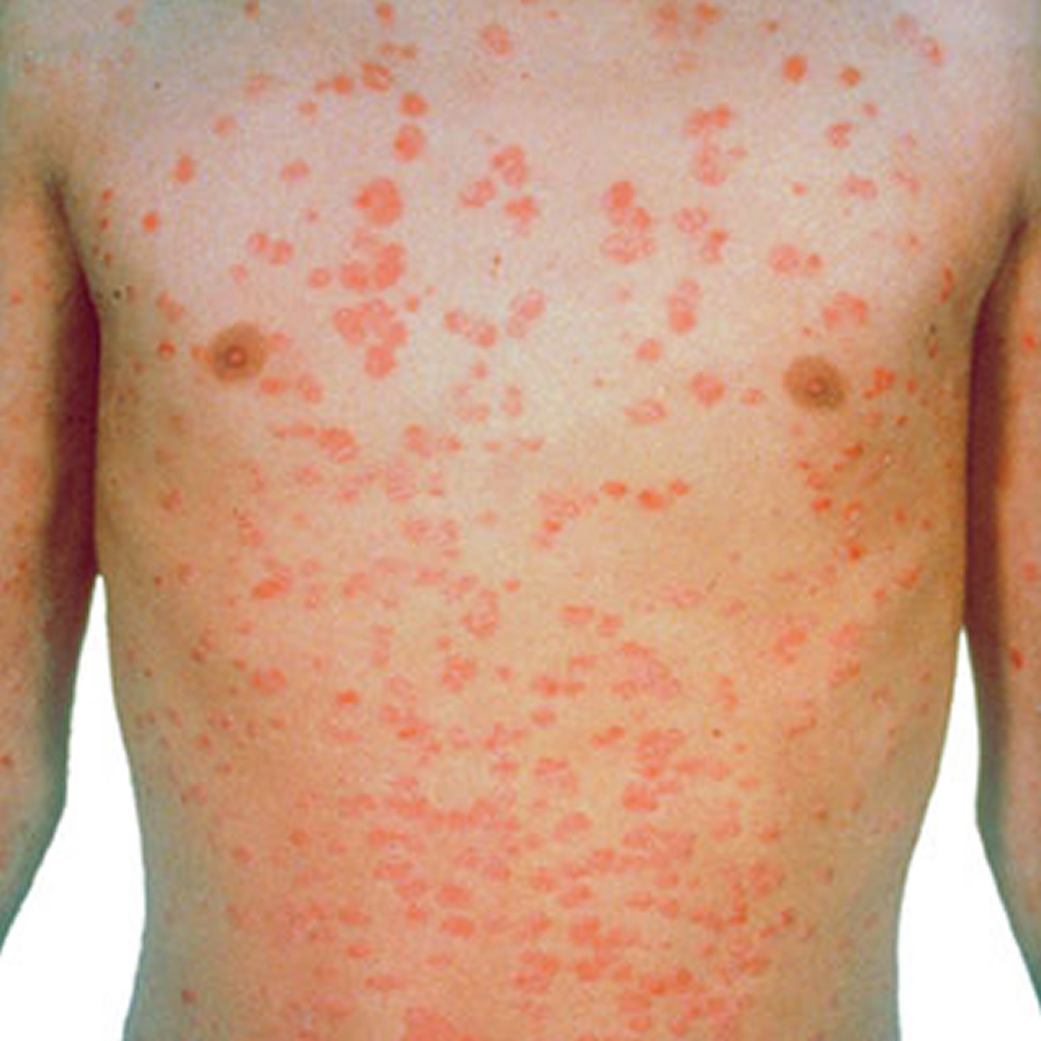 Guttate psoriasis