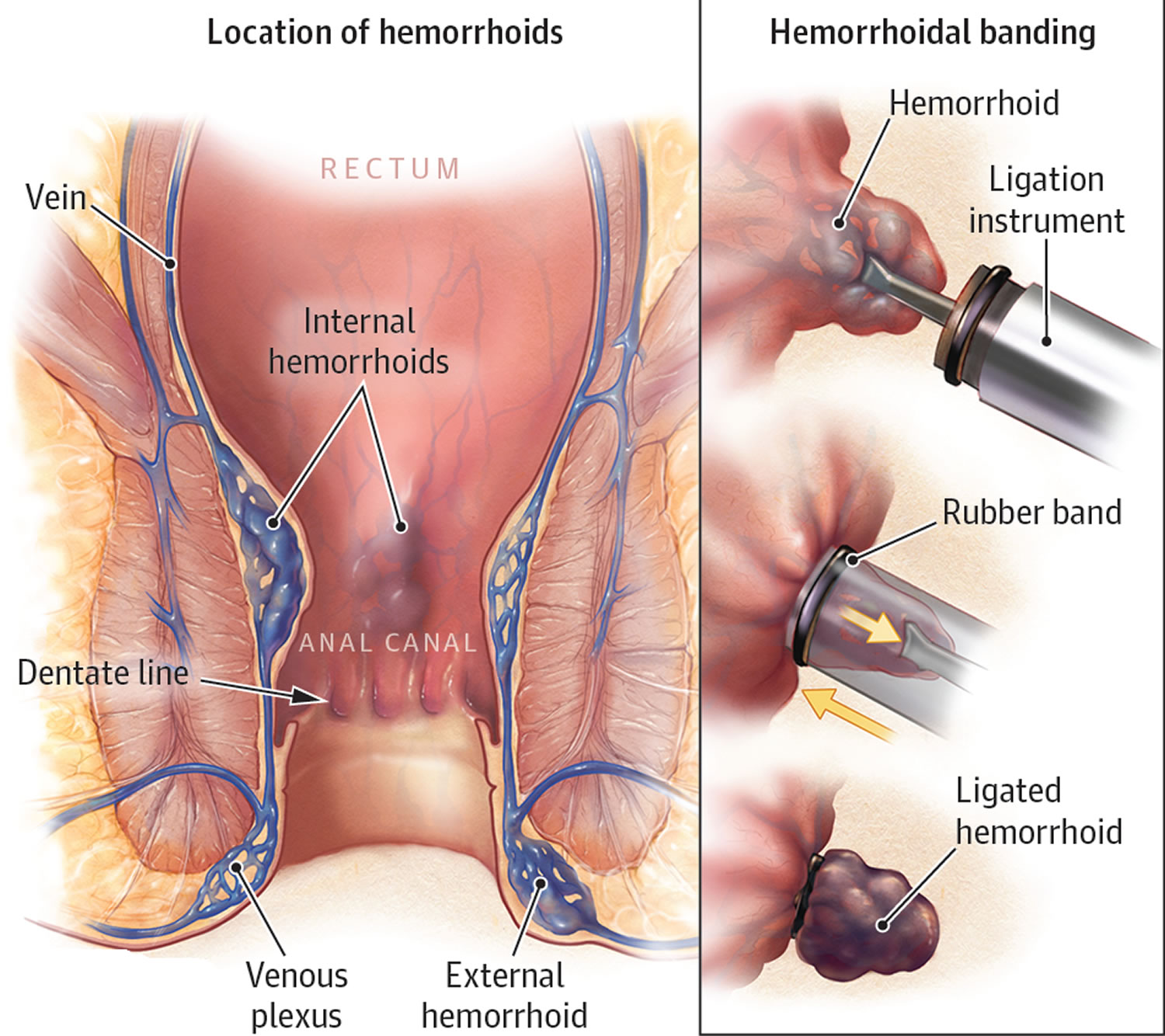 Hemorrhoids rubber band ligation