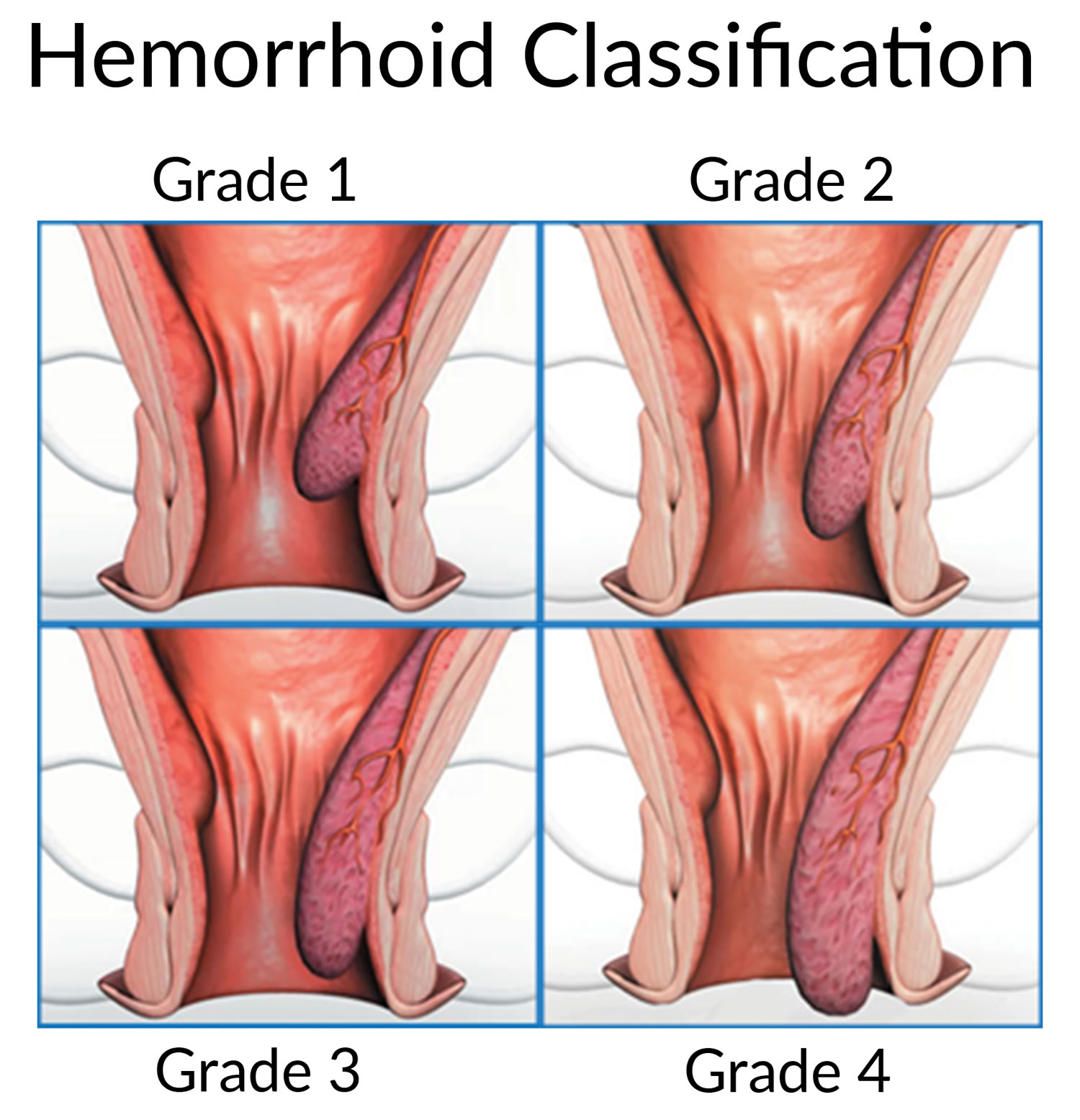 Rectal Prolapse - Causes, Symptoms and Treatment with Surgery