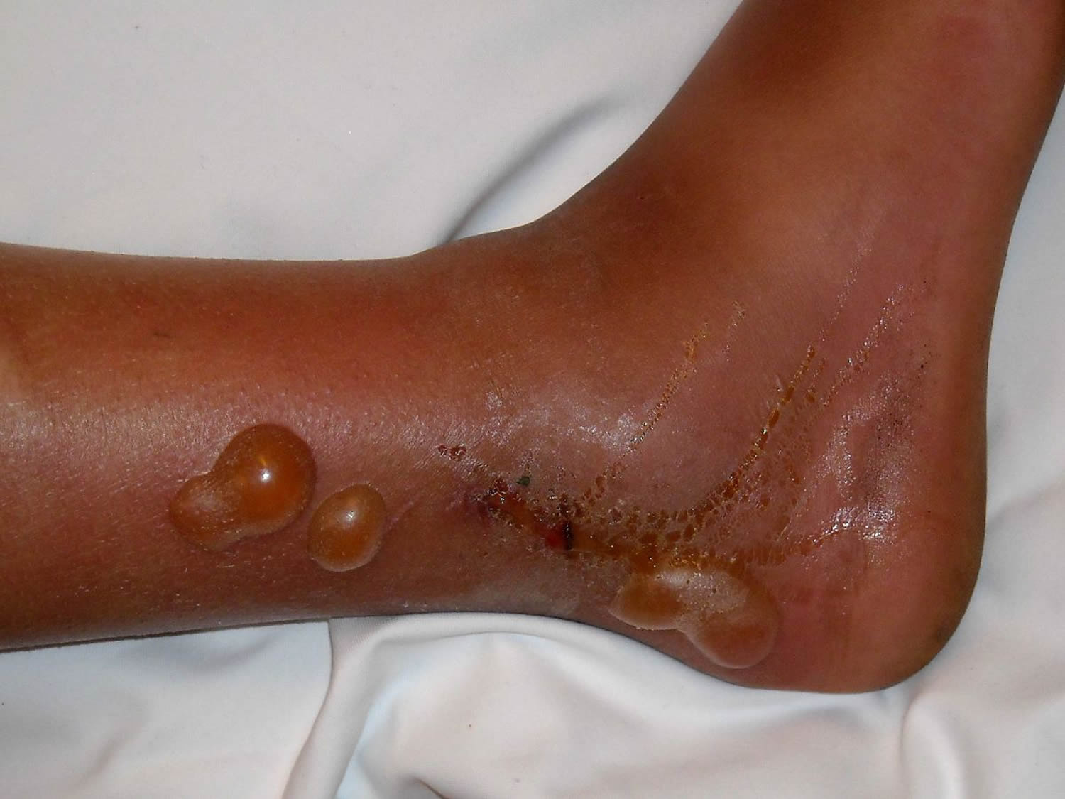 impetigo in adults legs