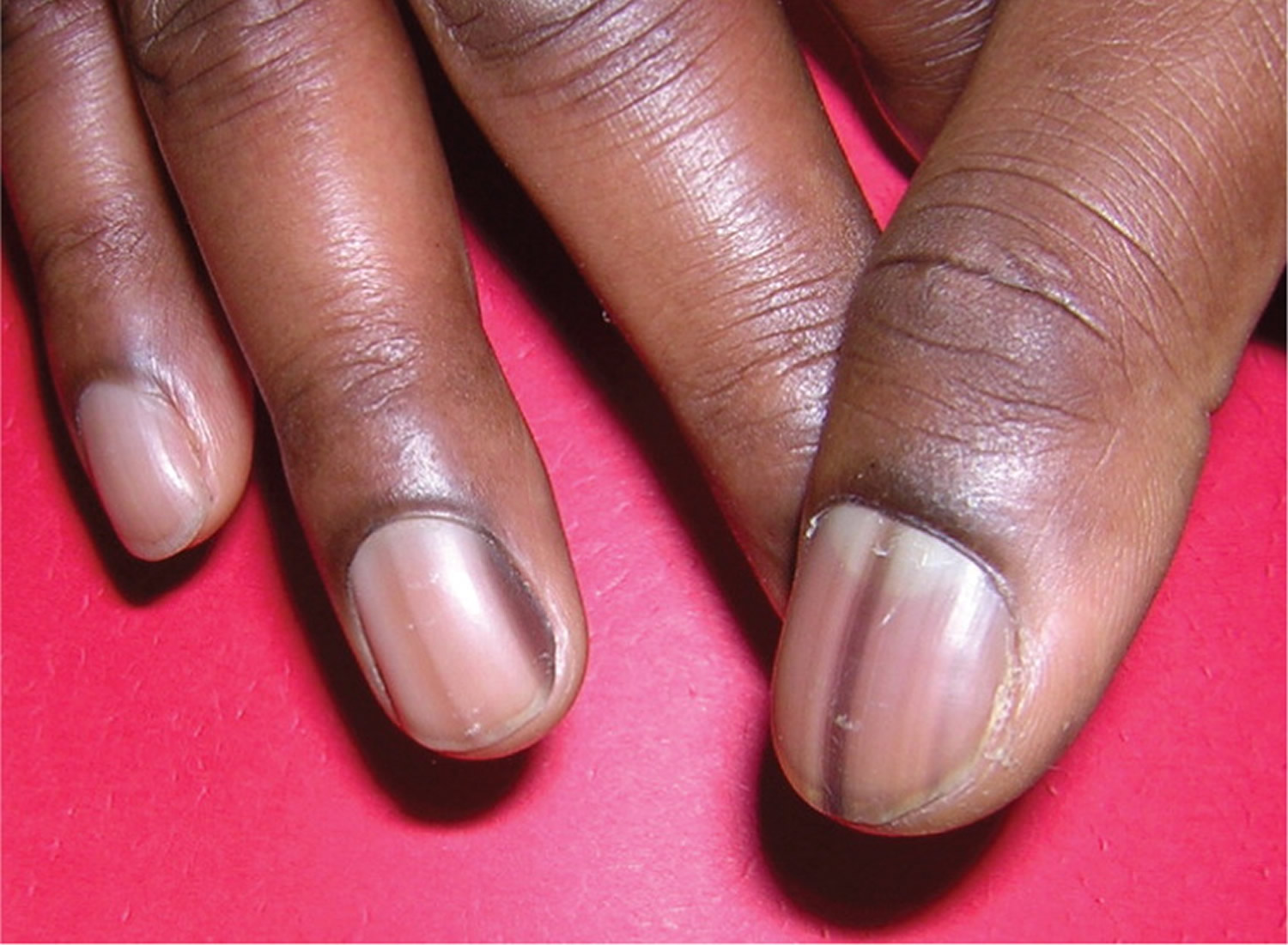 Fingernails - Ingrown fingernails - Dark Line - Fingernail Pain