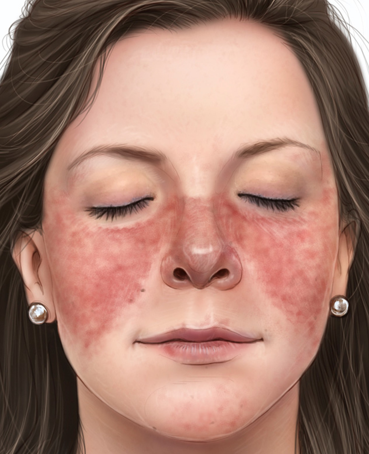 Lupus facial rash