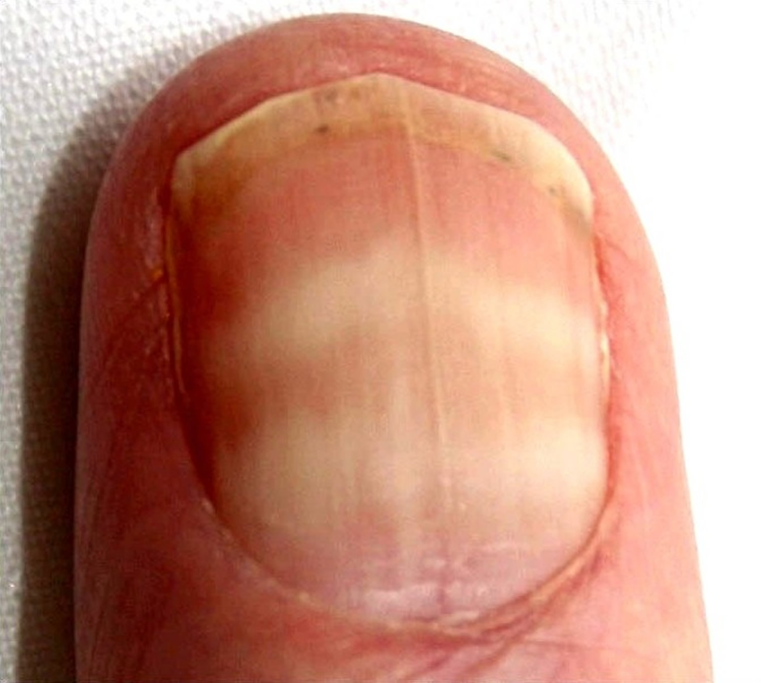 Fingernail Muehrcke Lines