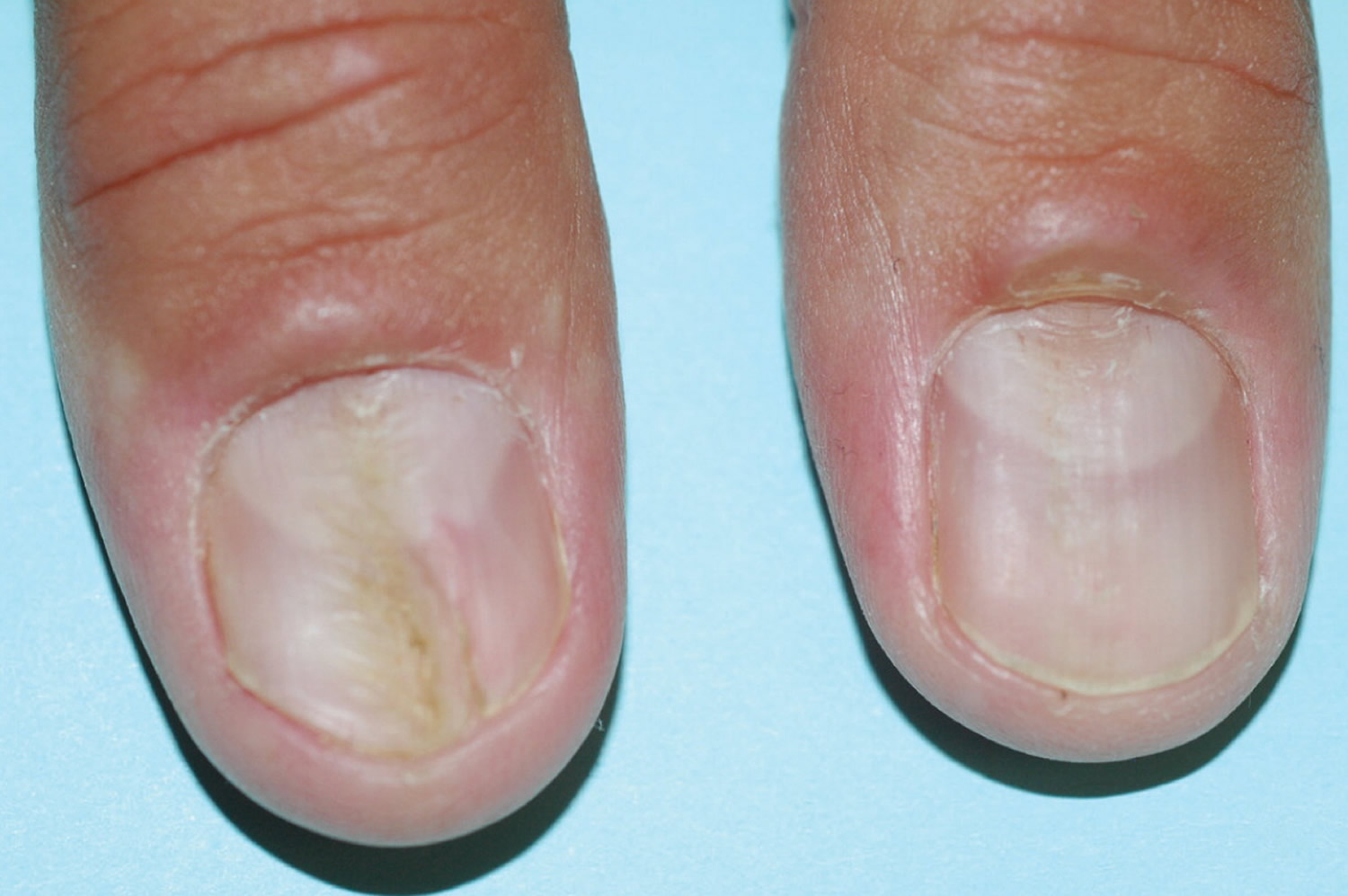 Median nail dystrophy