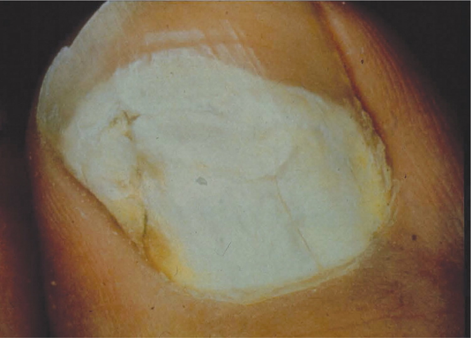 Proximal subungual onychomycosis