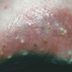 Pustular psoriasis
