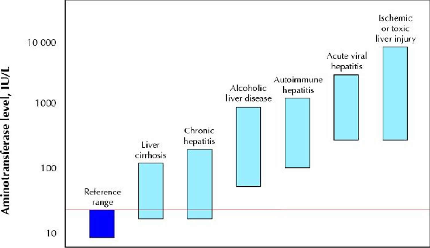 Serum aminotransferase levels in various liver diseases