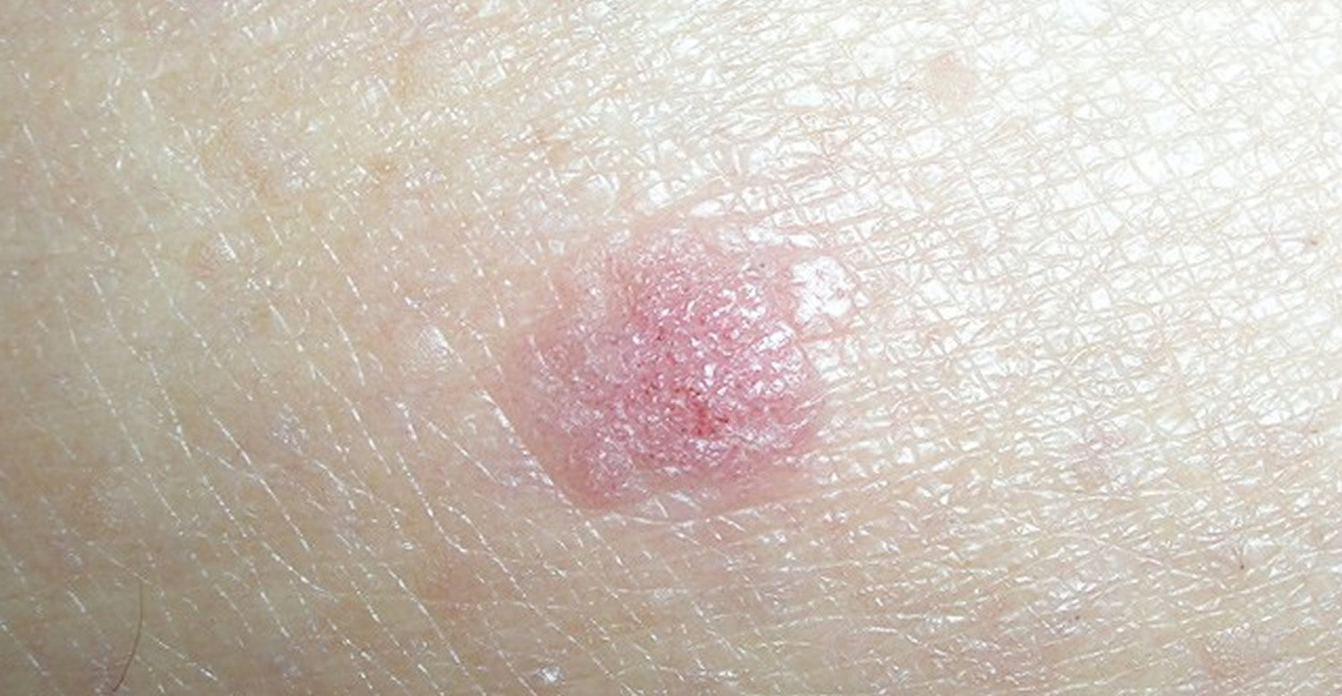 Squamous Cell Carcinoma Skin Cancer Symptoms