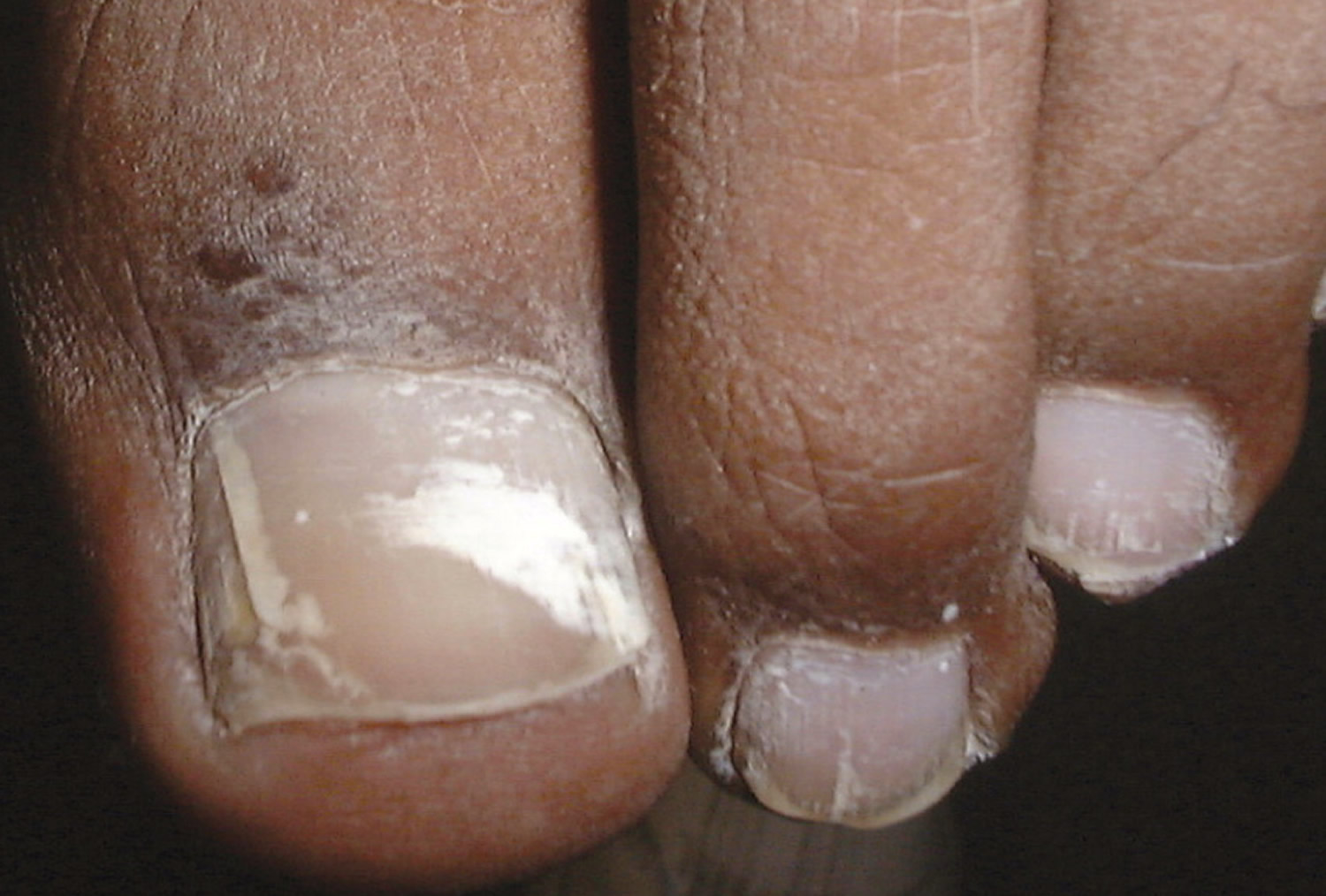 toenail-fungus-medication-treatment-home-remedies