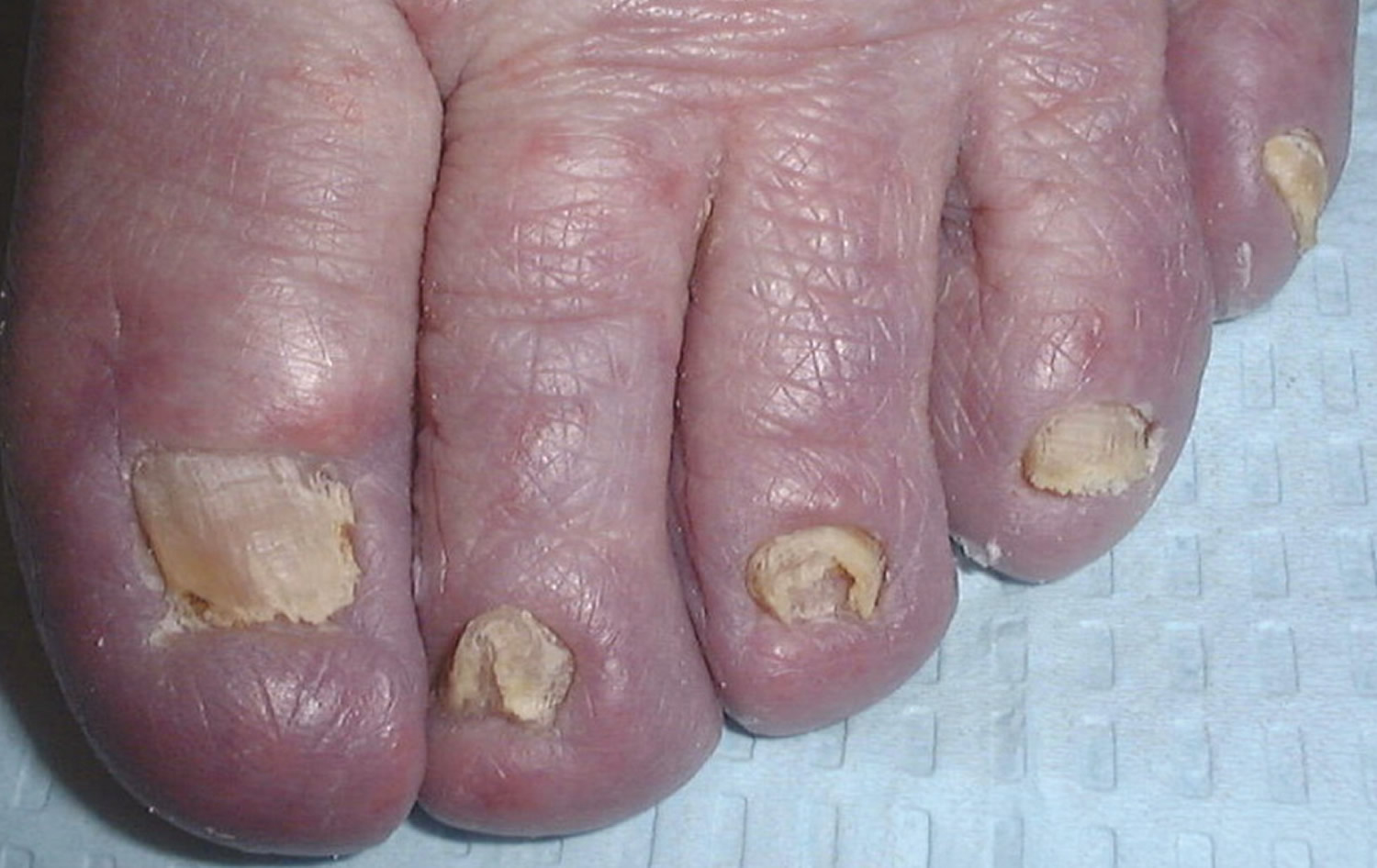 Total dystrophic onychomycosis