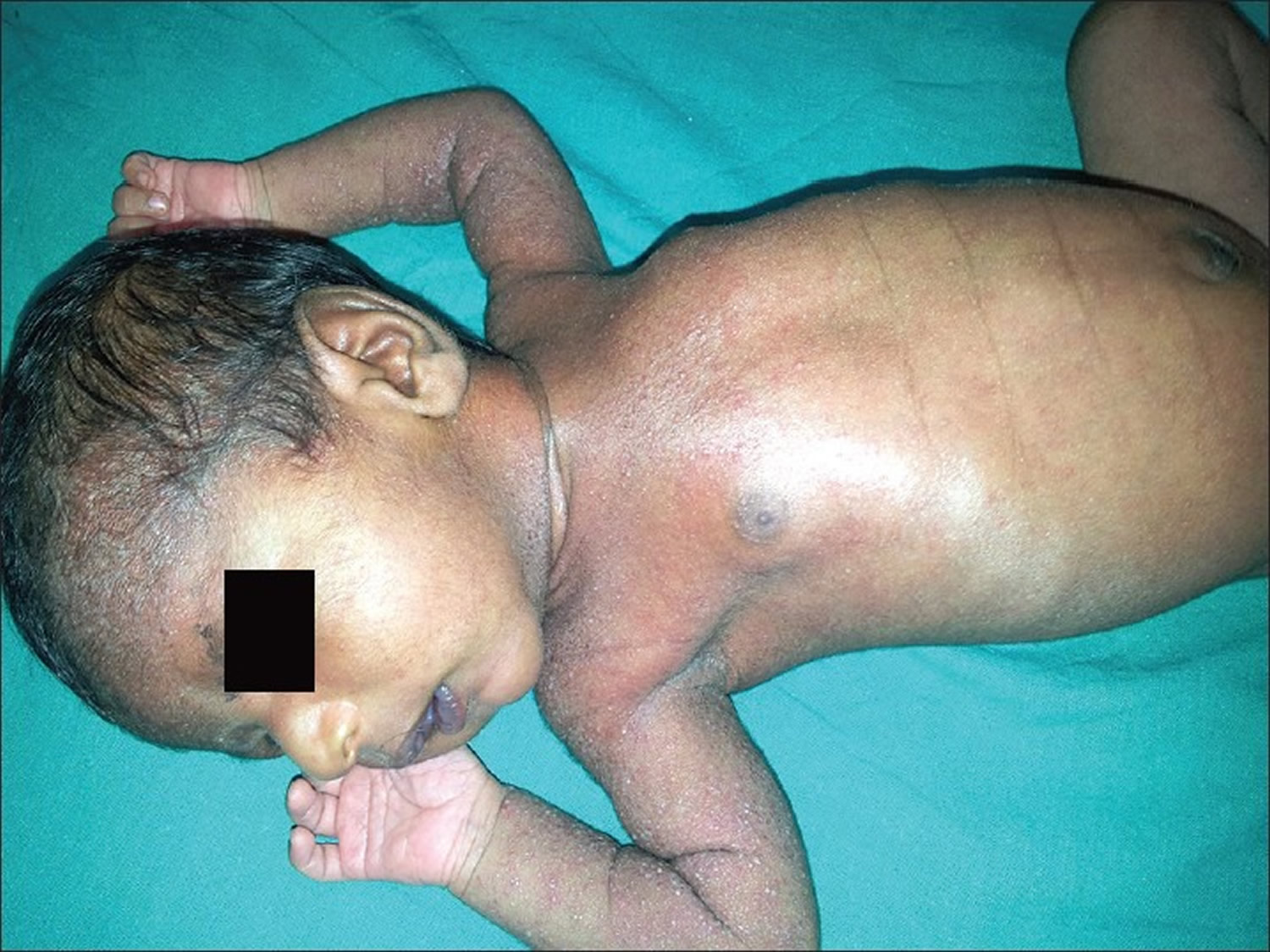 Transient neonatal pustular melanosis