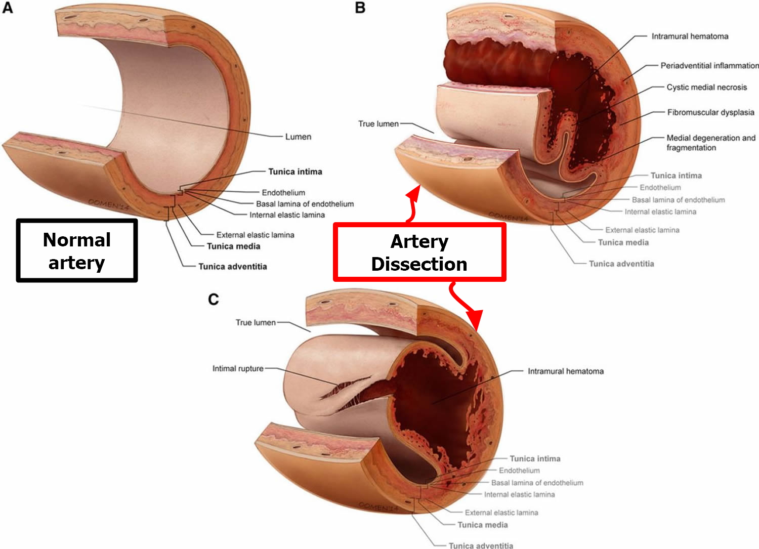 What Is Vertebral Artery Disease