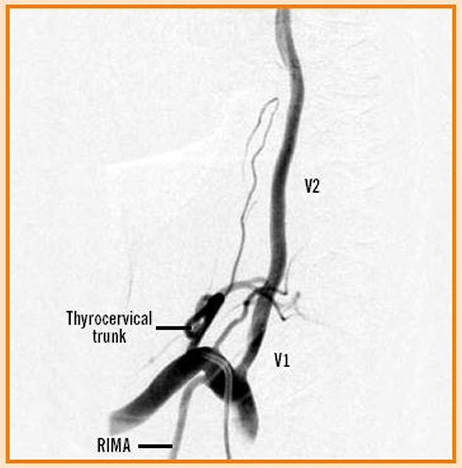 Vertebral artery segments angiogram