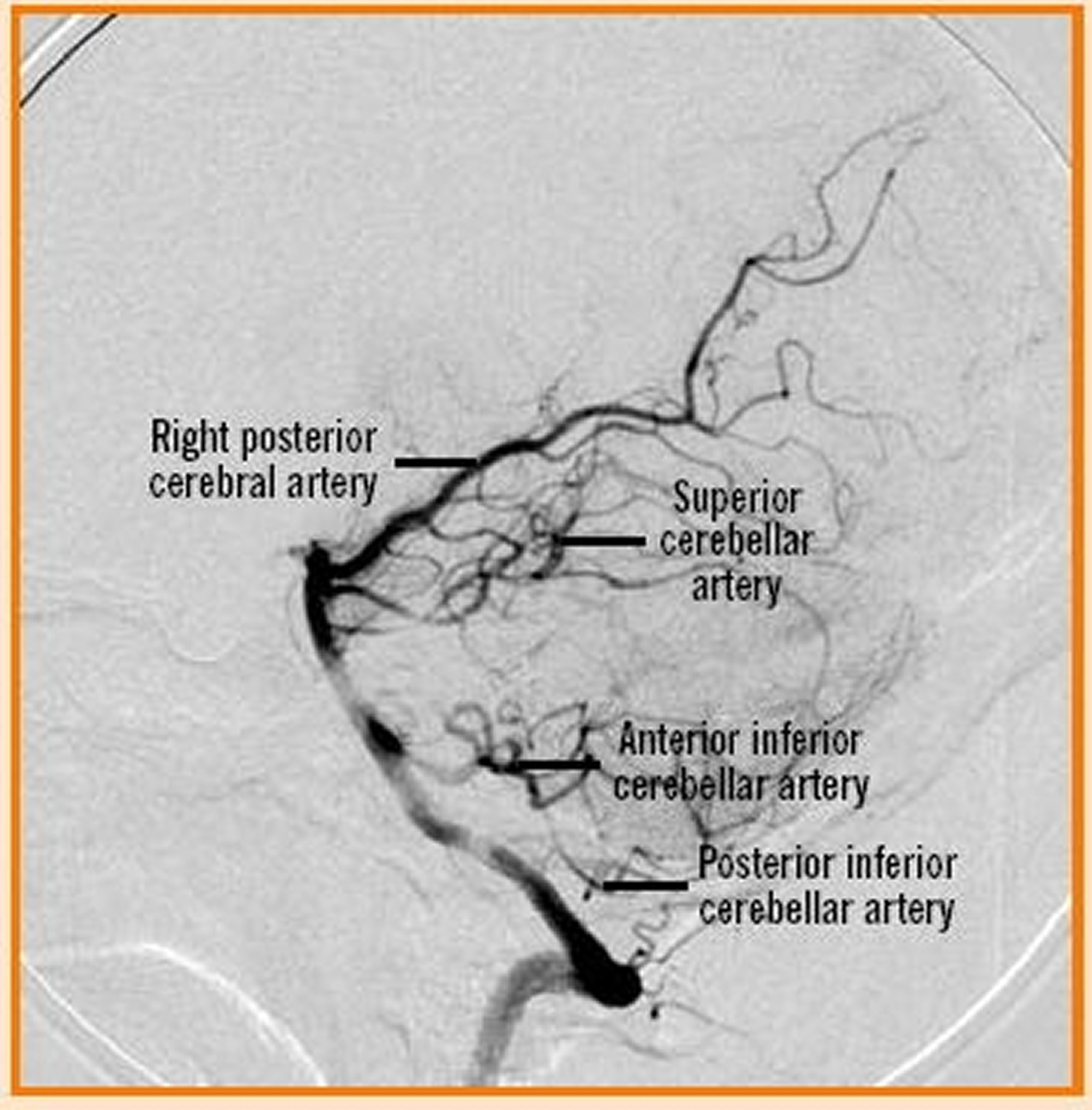 Vertebral artery segments - intracranial