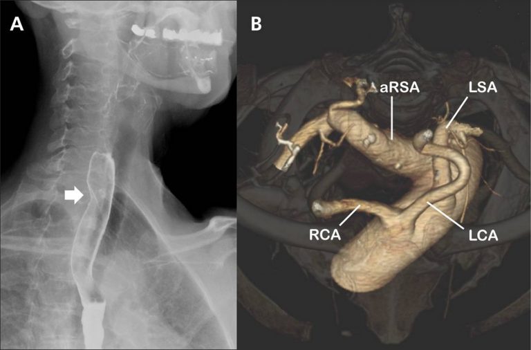 Left And Right Subclavian Artery Function Branches Stenosis