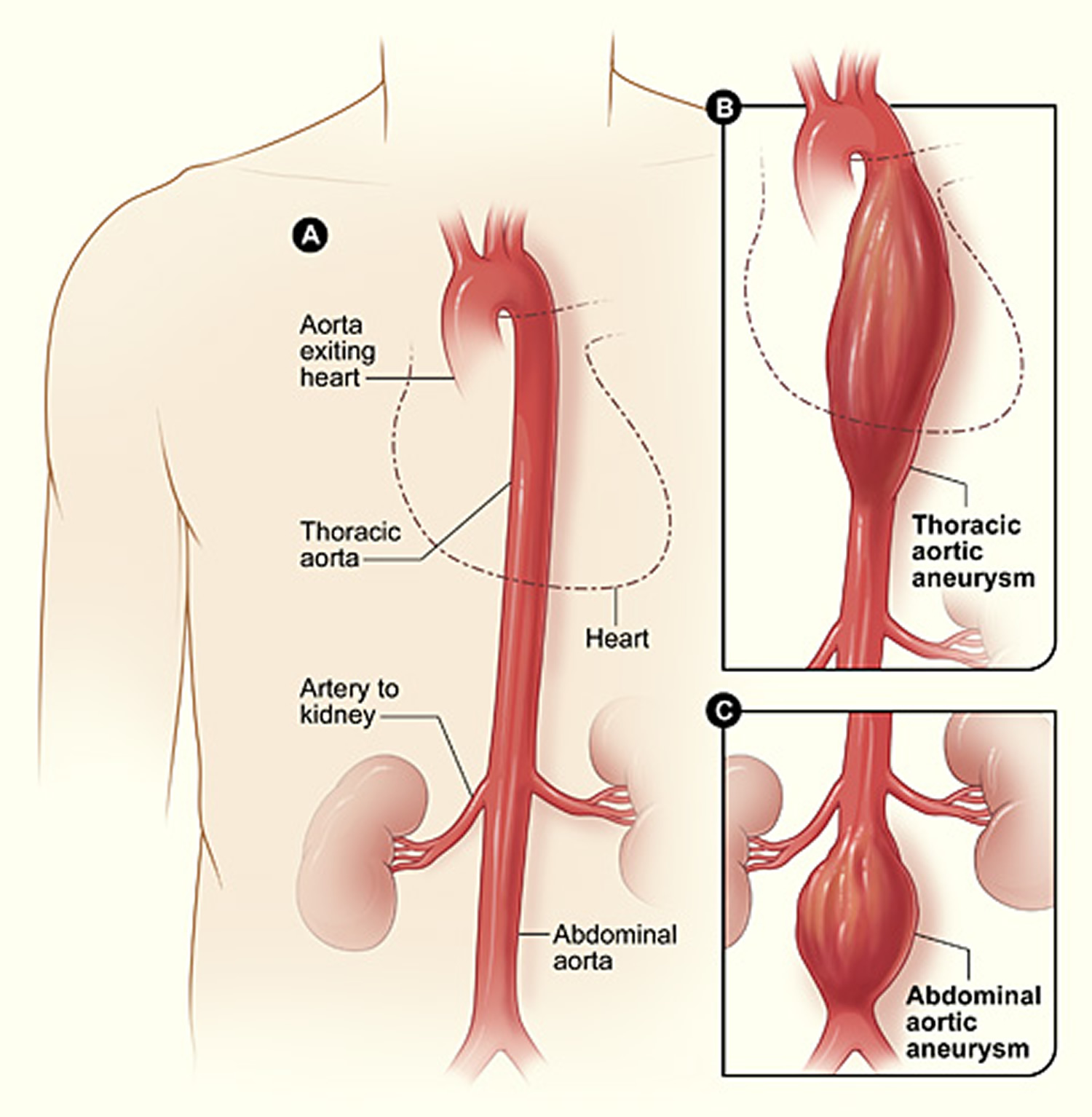symptoms of thoracic aortic aneurysm rupture